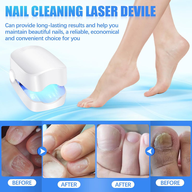 12915 Rechargeable Nail Fungus Treatment For Toenail Toe Nail Fungal Treatment Nail Fungus Laser Device Anti-fungal Nail Treatment For Hand  Feet Infections Remover For Home Use